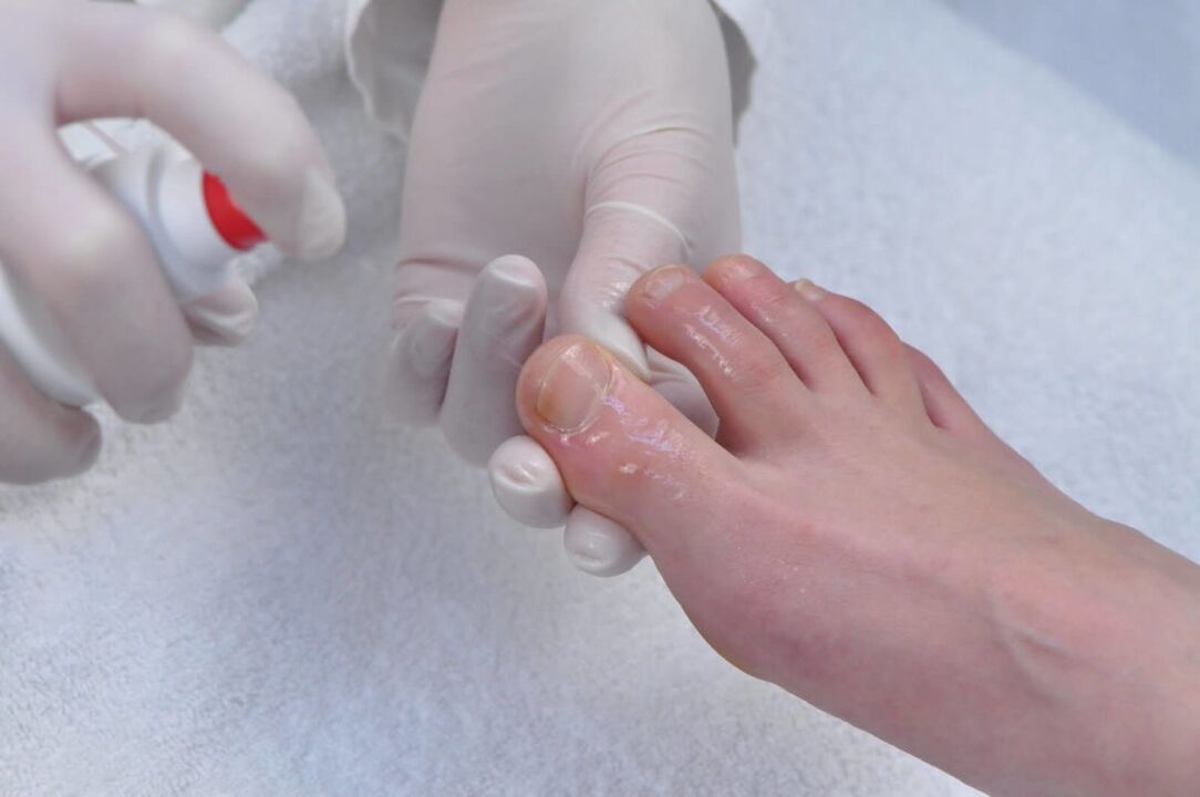Spray fir d'Behandlung vu Nagelpilz