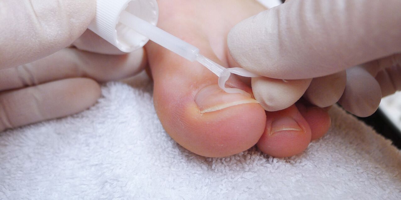 medizinesche Lack géint Nagelpilz