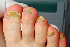 Nail filgus