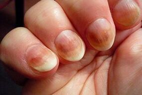 nail filgus