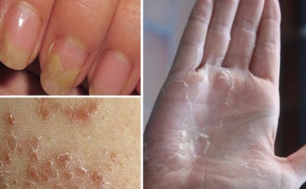 kann MyCosis wiesselen op aner Deeler vum Kierper