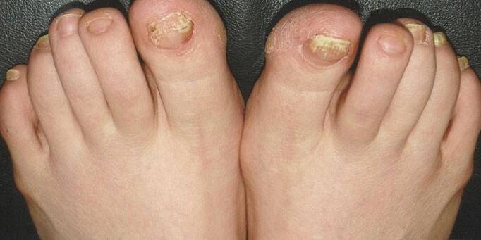 wat ass Nagelpilz